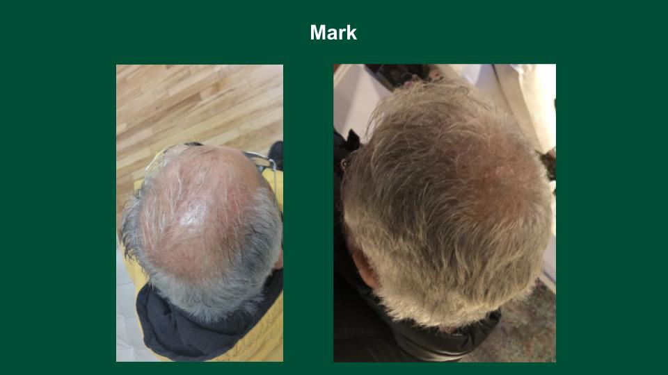 Exosome Hair Restoration Results